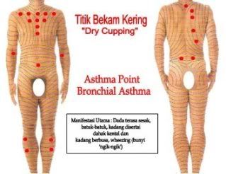 dry-cupping-asthma1.jpg